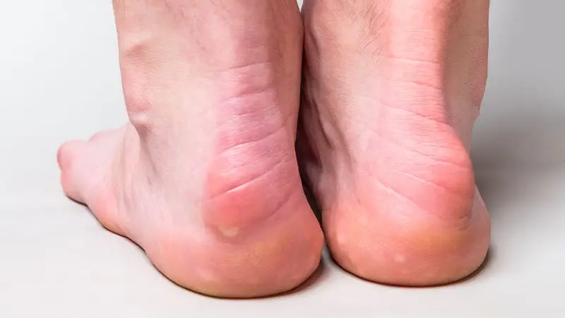 deformite cerrahisi uygulanacak topuk