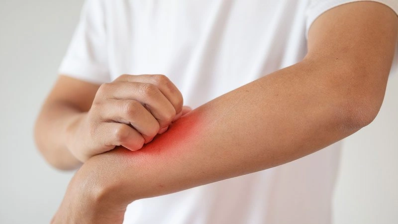 Dermatolojik Mantar Hastalıkları Sorunu Yaşayan Kişi