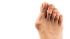 Halluks Valgus Problemli Ayak