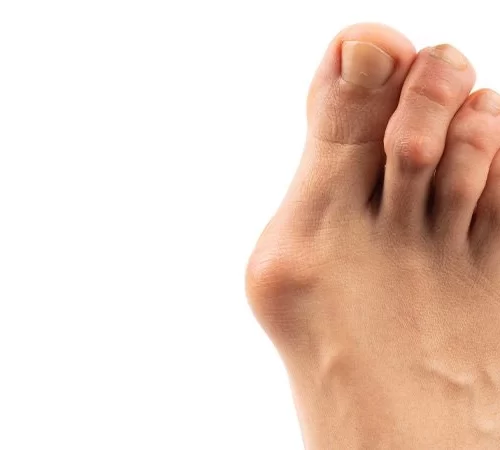 halluk-valgus-e Halluks Valgus Problemli Ayak