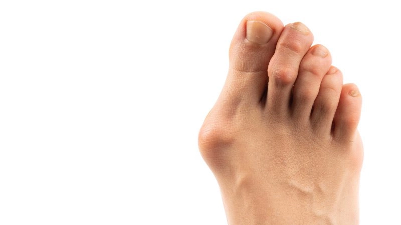 Halluks Valgus Problemli Ayak