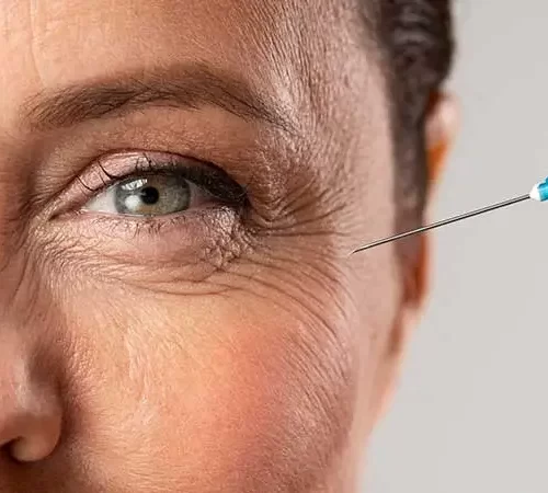 kirisiklik-tedavisi-m kırışıklık tedavisi uygulanan kadın
