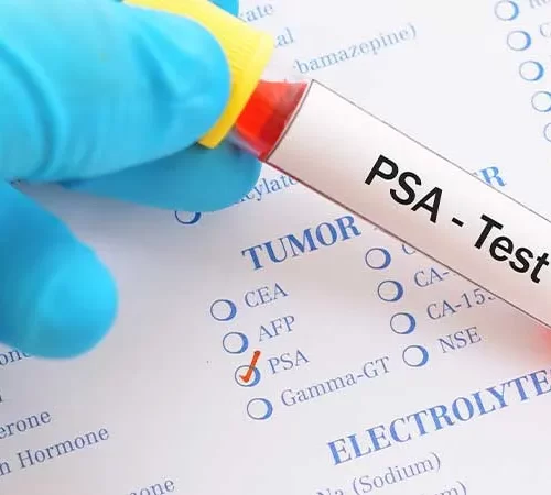 PSA (Prostat Spesifik Antijen)
