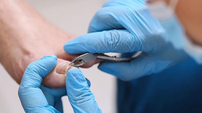 Tırnak Mantarı Tedavisi