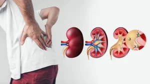 böbrek ve idrar yolu taşları sırt ağrısı yaşayan adam