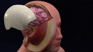 القحف الجمجمة (Cranioplasty)