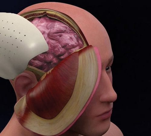 القحف الجمجمة (Cranioplasty)