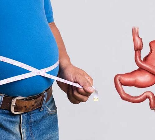جراحة تحويل مسار المعدة (Gastric Bypass)