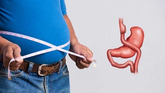 جراحة تحويل مسار المعدة (Gastric Bypass)