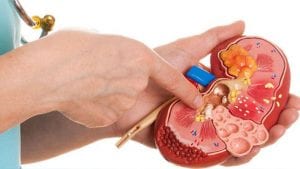 جراحة حصوات الكُلى