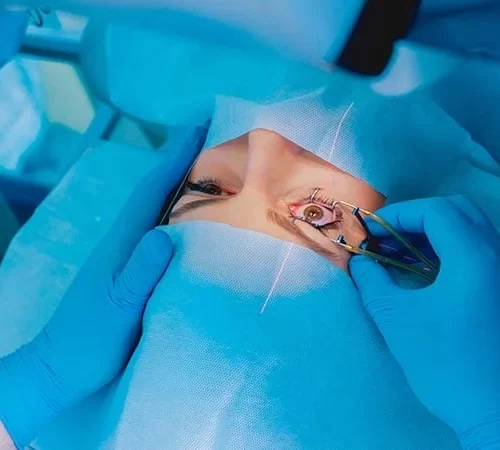 lasik-lazer-goz-ameliyati-e Lasik Lazer Göz Ameliyatı