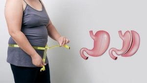 تكميم المعدة (Sleeve Gastrectomy)