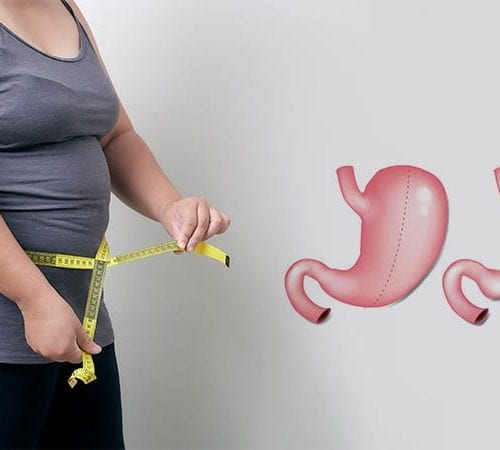 تكميم المعدة (Sleeve Gastrectomy)