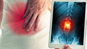 الدمج العنقي الخلفي ( Spinal Fusion)