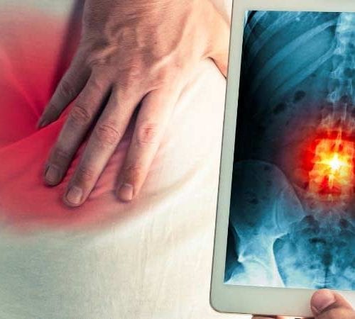 الدمج العنقي الخلفي ( Spinal Fusion)