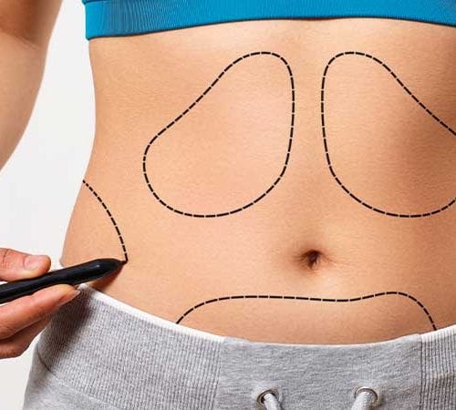 جراحة شد منطقة البطن