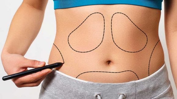 جراحة شد منطقة البطن