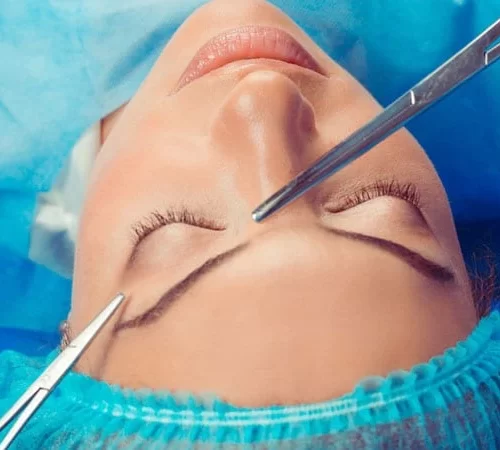 brow lift brow lift