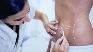 Liposuction What You Should Know?