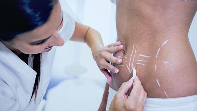 Liposuction What You Should Know?