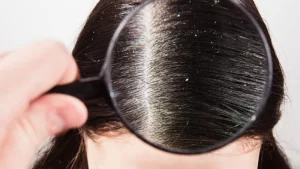 Saçta kepek sorunu yaşayan kadın