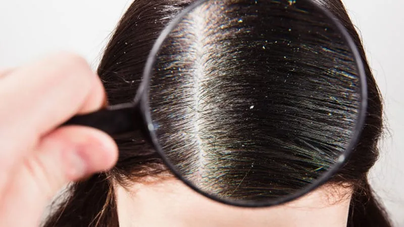 Saçta kepek sorunu yaşayan kadın