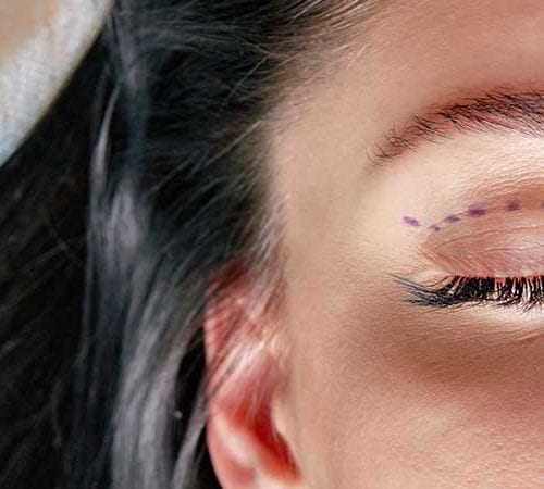 عملية رفع الجفن (Blepharoplasty)