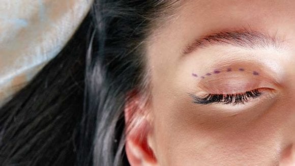 عملية رفع الجفن (Blepharoplasty)