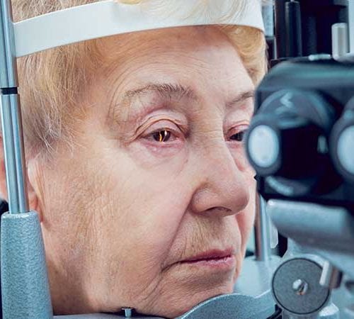 إعتام عدسة العين | مرض إعتام عدسة العين (Cataracts)