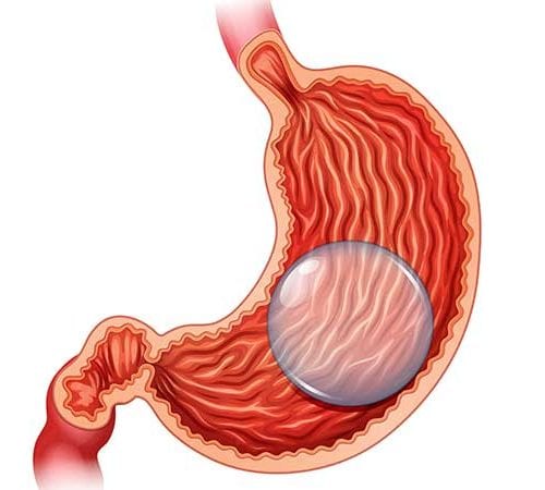 إدخال بالون داخل المعدة (Intragastric balloon)