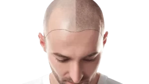 erkek saç ekimi öncesi sonrası görünümü