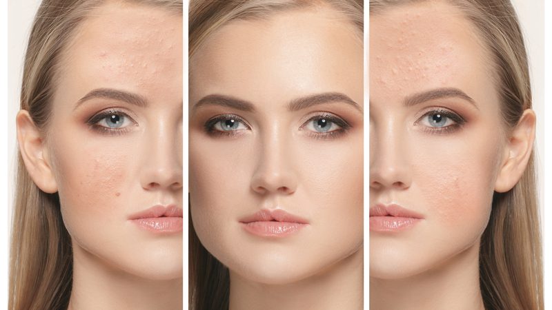 Dermapen Öncesi ve Sonrası Cilt Nasıl Görünür?