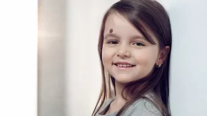 Alında doğum lekesi olan kız çocuğu