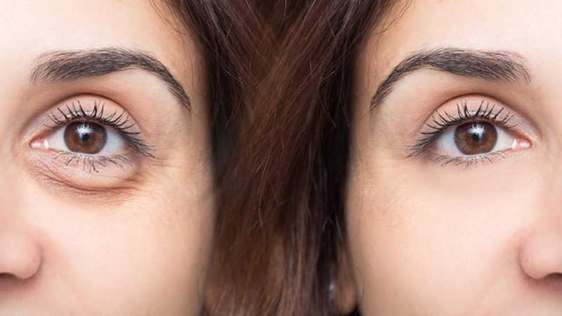 Göz Altı Torbası Ameliyatı Öncesi ve Sonrası Fotoğrafı