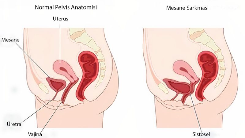 Mesane Sarkması Görüntüsü