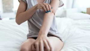 Uyuz hastalığı belirtileri taşıyan kadın