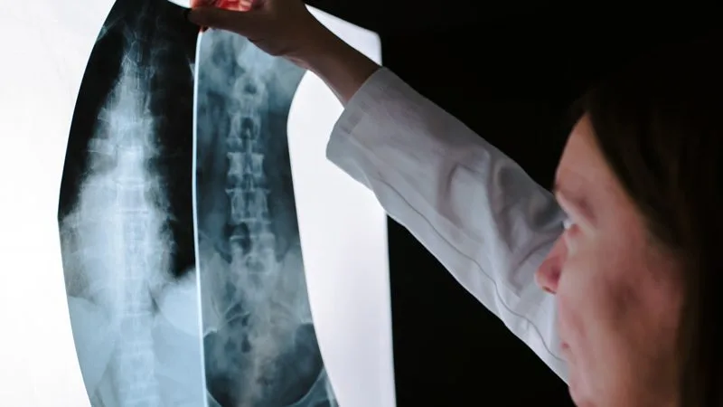 Omurga Stres Kırığı Röntgen Filmi