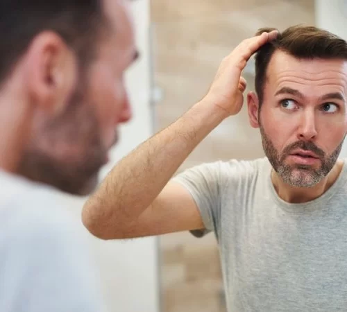saç ekimi sonrası şok dökülme yaşayan erkek aynaya bakıyor