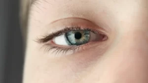 göz uçuğu yüzünden göz sulanması yaşayan kadın