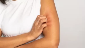 Böcek arı alerjisi olan kadın