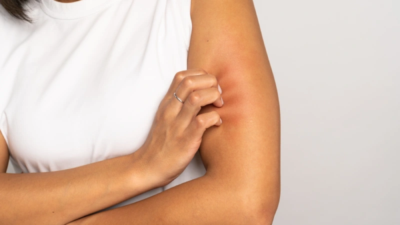 Böcek arı alerjisi olan kadın