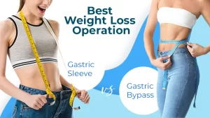Gastric Sleeve VS Gastric Bypass