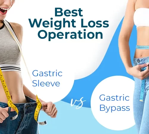 gastric-sleeve-bypass-c Gastric Sleeve VS Gastric Bypass