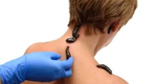 sırtına sülük tedavisi uygulanan kadın