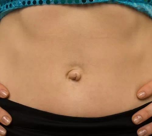 Göbek fıtığı belirtileri olan kadın