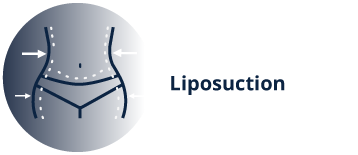 Liposuction