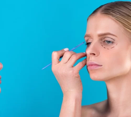 Blefaroplasti (Göz kapağı estetiği) ameliyatı öncesi