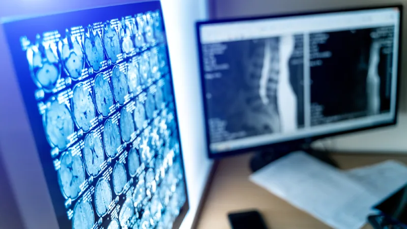 Beyin emarı neden çekilir