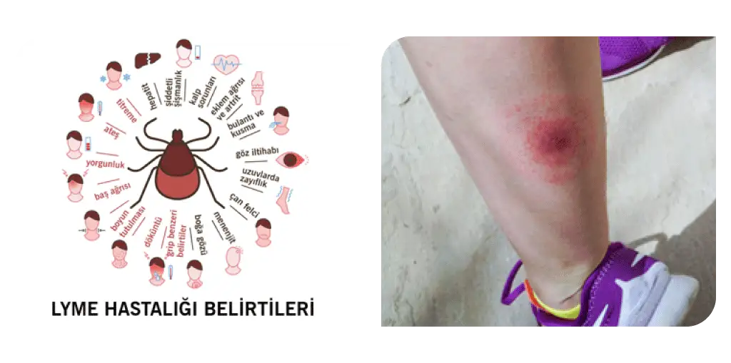 lyme hastalığı
