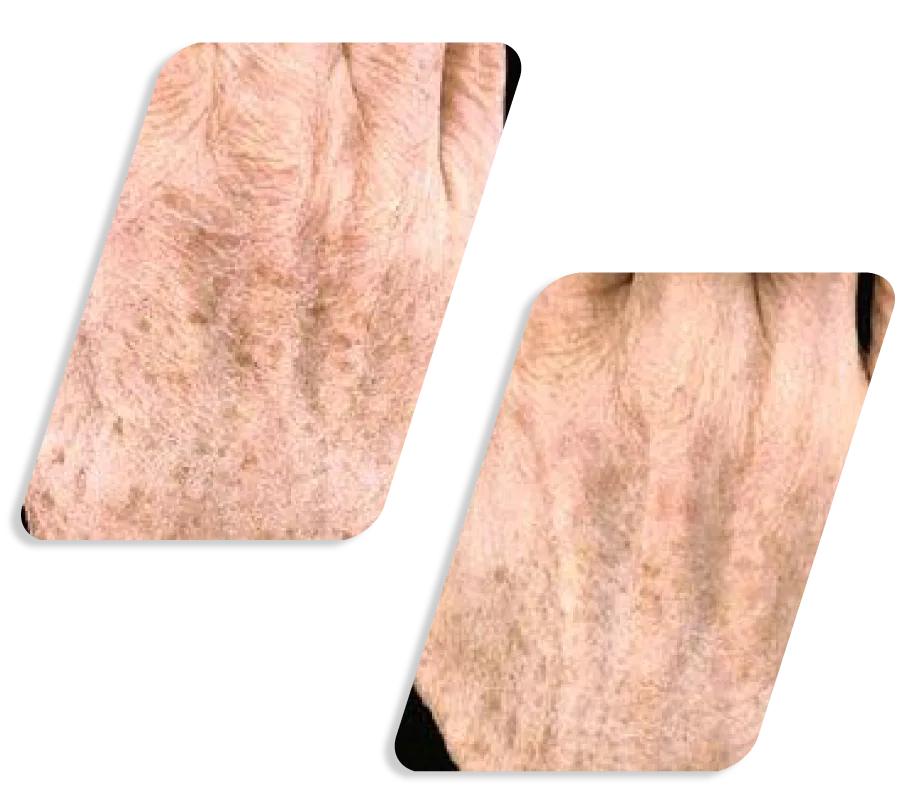 Q Switch Lazer Before After